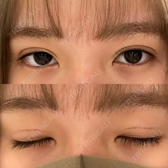 二重埋没 城本クリニック 名古屋院 DAY 0 メイン用