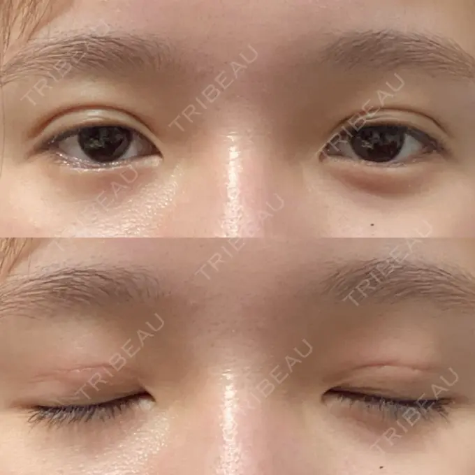 二重埋没 城本クリニック 名古屋院 DAY 1 メイン用