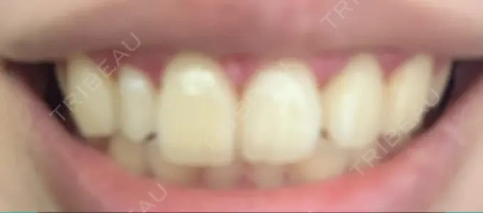 ガミースマイル手術 / その他（口元） / その他（審美歯科/矯正歯科） 南青山矯正歯科 DAY 11 メイン用