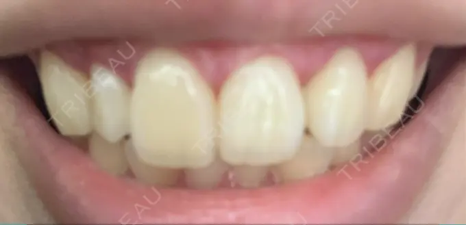 ガミースマイル手術 / その他（口元） / その他（審美歯科/矯正歯科） 南青山矯正歯科 DAY 12 メイン用