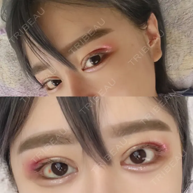 二重切開 / 目頭切開 / 目尻切開 / 上まぶたの脂肪取り / タレ目形成・グラマラスライン（切開） レアート整形外科 DAY 19 メイン用