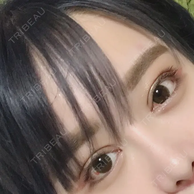 二重切開 / 目頭切開 / 目尻切開 / 上まぶたの脂肪取り / タレ目形成・グラマラスライン（切開） レアート整形外科 DAY 14 メイン用