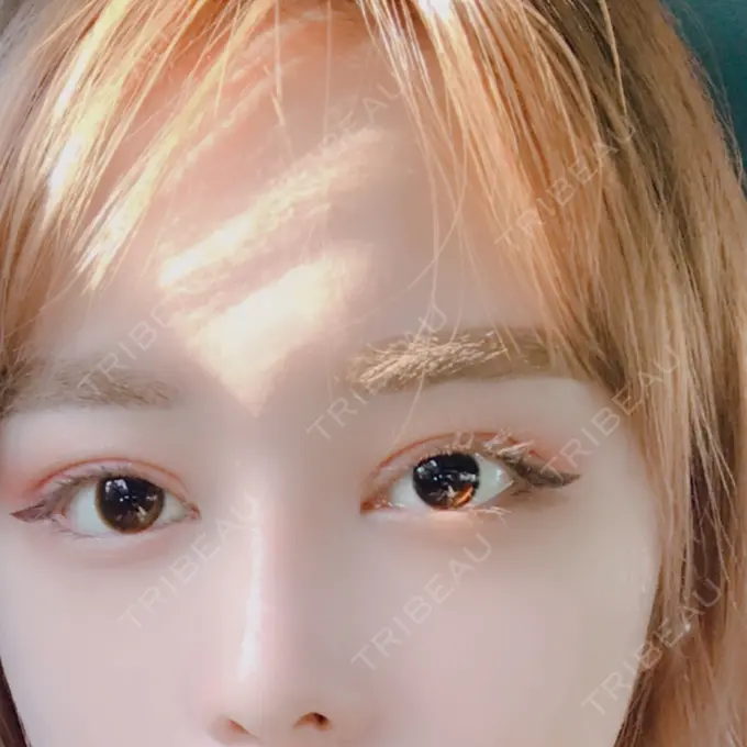 二重切開 / 目頭切開 / 目尻切開 / 上まぶたの脂肪取り / タレ目形成・グラマラスライン（切開） レアート整形外科 DAY 81 メイン用