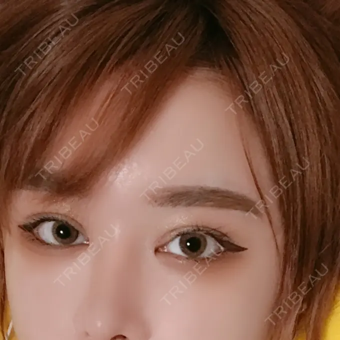 二重切開 / 目頭切開 / 目尻切開 / 上まぶたの脂肪取り / タレ目形成・グラマラスライン（切開） レアート整形外科 DAY 69 メイン用