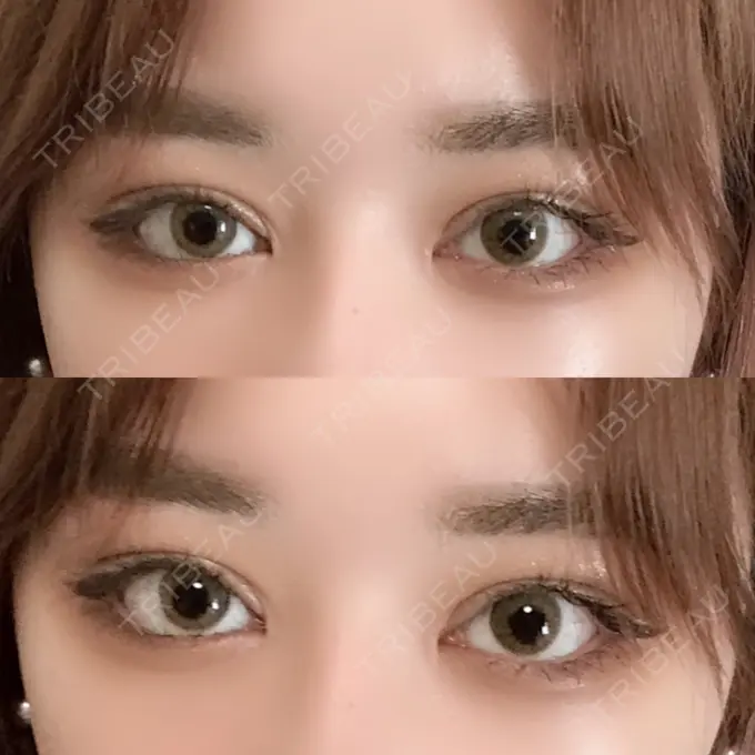 二重切開 / 目頭切開 / 目尻切開 / 上まぶたの脂肪取り / タレ目形成・グラマラスライン（切開） レアート整形外科 DAY 66 メイン用