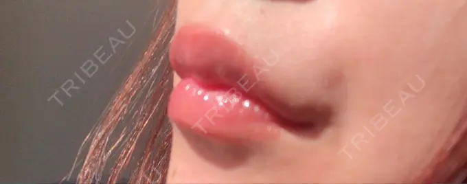 人中短縮 / ヒアルロン酸注入（唇） / ボトックス（口角） ルラ美容クリニック 高田馬場院 DAY 10 メイン用