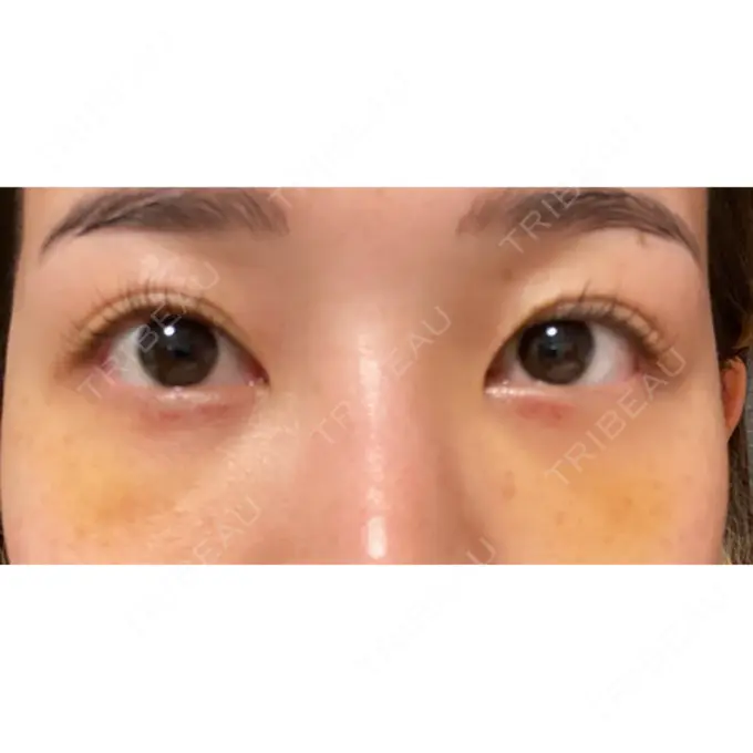 クマ治療 / 下まぶたの脂肪取り ルラ美容クリニック 高田馬場院 DAY 5 メイン用