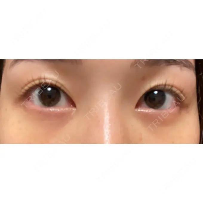 クマ治療 / 下まぶたの脂肪取り ルラ美容クリニック 高田馬場院 DAY 7 メイン用