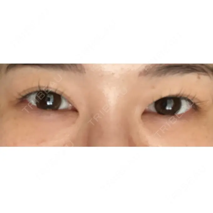 クマ治療 / 下まぶたの脂肪取り ルラ美容クリニック 高田馬場院 DAY 30 メイン用