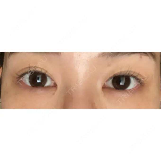 クマ治療 / 下まぶたの脂肪取り ルラ美容クリニック 高田馬場院 DAY 30 メイン用