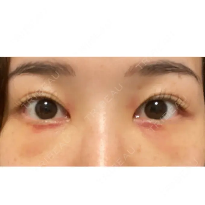 クマ治療 / 下まぶたの脂肪取り ルラ美容クリニック 高田馬場院 DAY 4 メイン用