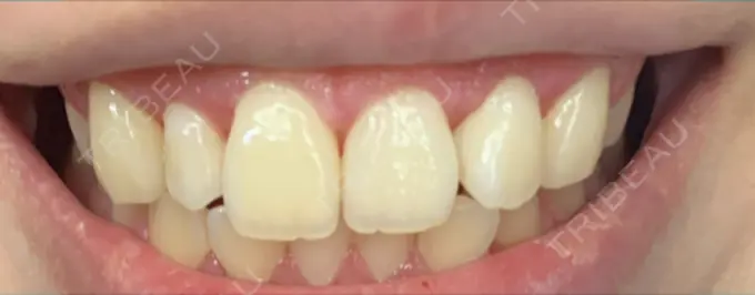 ガミースマイル手術 / その他（口元） / その他（審美歯科/矯正歯科） 南青山矯正歯科 DAY 13 メイン用