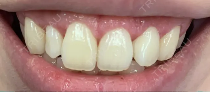 ガミースマイル手術 / その他（口元） / その他（審美歯科/矯正歯科） 南青山矯正歯科 DAY 14 メイン用