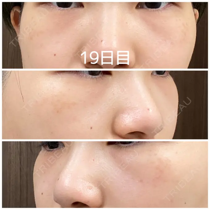 クマ治療 / 下まぶたの脂肪取り / 脂肪注入（輪郭） 湘南美容クリニック 橋本院 AFTER メイン用