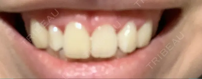 ガミースマイル手術 / その他（口元） / その他（審美歯科/矯正歯科） 南青山矯正歯科 AFTER メイン用