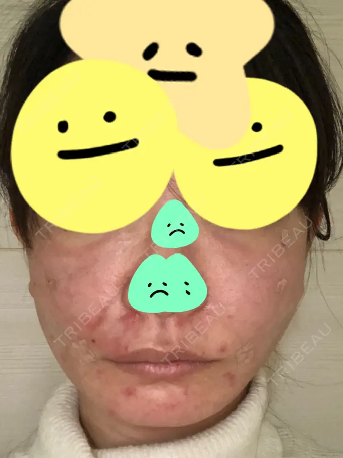 糸リフト / 脂肪吸引（顔） / 脂肪注入（肌） / メーラーファット除去 / ボトックス（エラ・小顔） 湘南美容クリニック 秋葉原院 DAY 0 メイン用