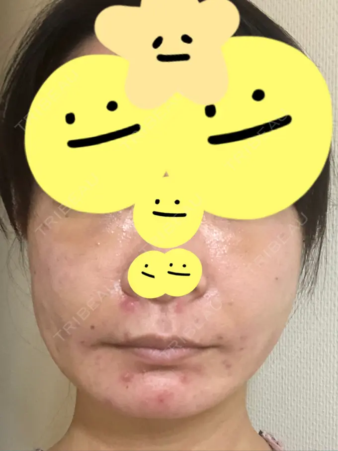 糸リフト / 脂肪吸引（顔） / 脂肪注入（肌） / メーラーファット除去 / ボトックス（エラ・小顔） 湘南美容クリニック 秋葉原院 DAY 1 メイン用