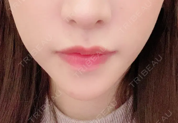 あごプロテーゼ / 骨切り（あご） / 脂肪吸引（顔） 心斎橋コムロ美容外科クリニック AFTER メイン用