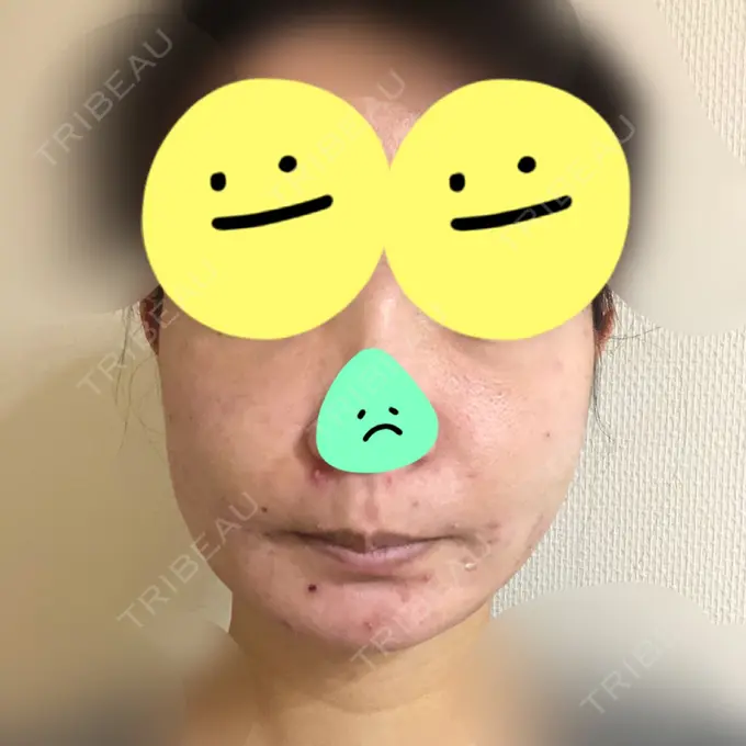 糸リフト / 脂肪吸引（顔） / 脂肪注入（肌） / メーラーファット除去 / ボトックス（エラ・小顔） 湘南美容クリニック 秋葉原院 DAY 2 メイン用