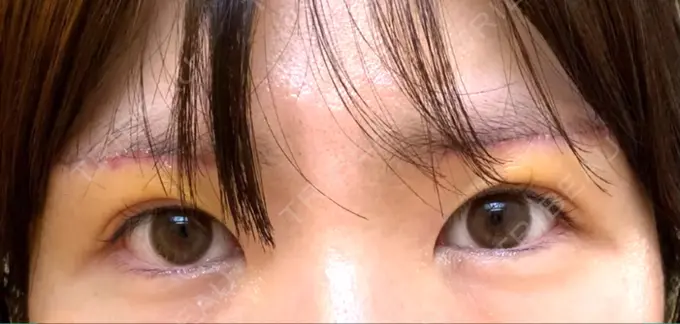 眉下切開 城本クリニック 福岡院 DAY 3 メイン用