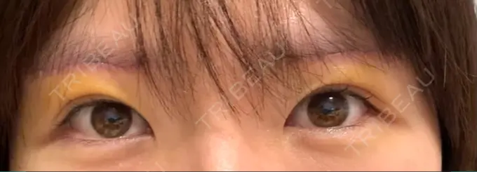 眉下切開 城本クリニック 福岡院 DAY 4 メイン用