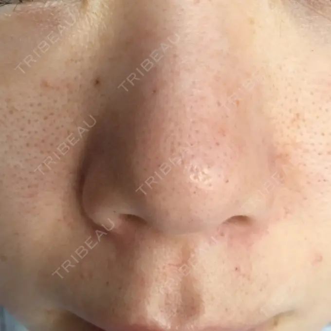 毛穴洗浄（ハイドラフェイシャルなど） / ピコレーザートーニング（美白・肝斑） / フラクショナルレーザー（毛穴・ニキビ跡） B-LINE CLINIC 池袋院 DAY 1 メイン用