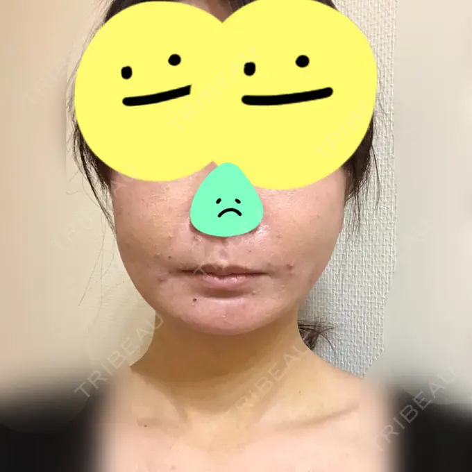 糸リフト / 脂肪吸引（顔） / 脂肪注入（肌） / メーラーファット除去 / ボトックス（エラ・小顔） 湘南美容クリニック 秋葉原院 DAY 3 メイン用