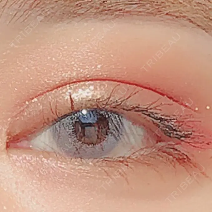 二重切開 / 目頭切開 / 目尻切開 / 上まぶたの脂肪取り / タレ目形成・グラマラスライン（切開） レアート整形外科 DAY 27 メイン用