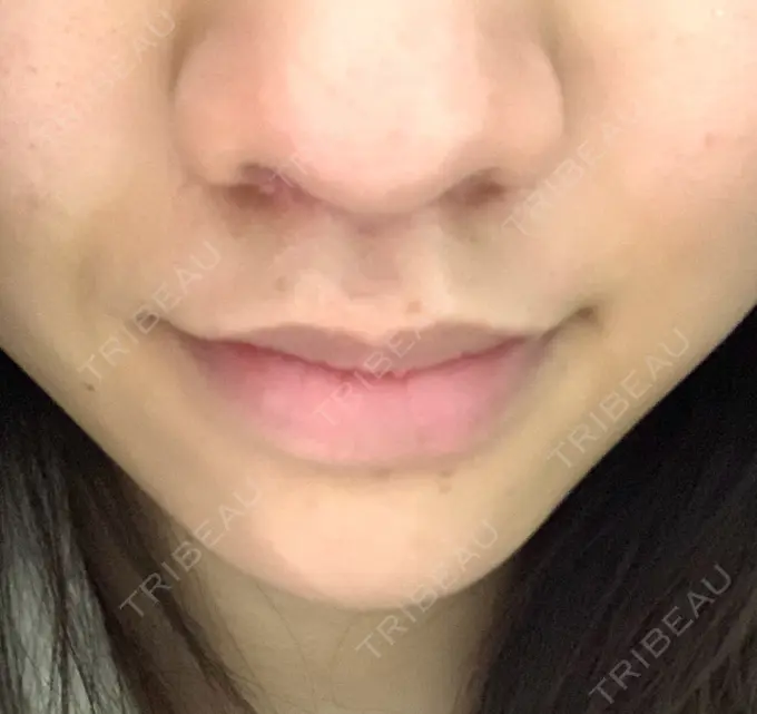 人中短縮 新宿ラクル美容外科クリニック 新宿院 DAY 20 メイン用