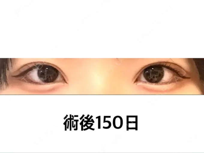 二重埋没 フェアクリニック川口 AFTER メイン用