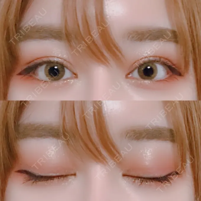 二重切開 / 目頭切開 / 目尻切開 / 上まぶたの脂肪取り / タレ目形成・グラマラスライン（切開） レアート整形外科 DAY 94 メイン用