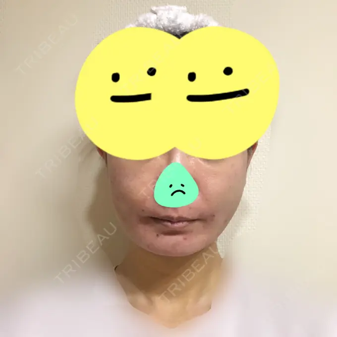 糸リフト / 脂肪吸引（顔） / 脂肪注入（肌） / メーラーファット除去 / ボトックス（エラ・小顔） 湘南美容クリニック 秋葉原院 DAY 4 メイン用