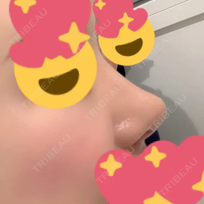 鼻尖形成（切開） / 小鼻縮小（切開） / 軟骨移植 / ワシ鼻修正・ハンプ切除 / 鼻尖縮小 / その他（鼻） B-LINE CLINIC 池袋院 AFTER メイン用