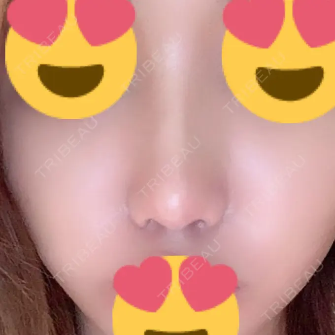 鼻尖形成（切開） / 小鼻縮小（切開） / 軟骨移植 / ワシ鼻修正・ハンプ切除 / 鼻尖縮小 / その他（鼻） B-LINE CLINIC 池袋院 DAY 267 メイン用