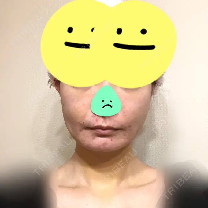 糸リフト / 脂肪吸引（顔） / 脂肪注入（肌） / メーラーファット除去 / ボトックス（エラ・小顔） 湘南美容クリニック 秋葉原院 DAY 6 メイン用