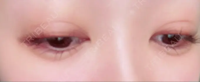 二重埋没 / ヒアルロン酸注入（目の下） EMMA CLINIC（エマクリニック） DAY 7 メイン用