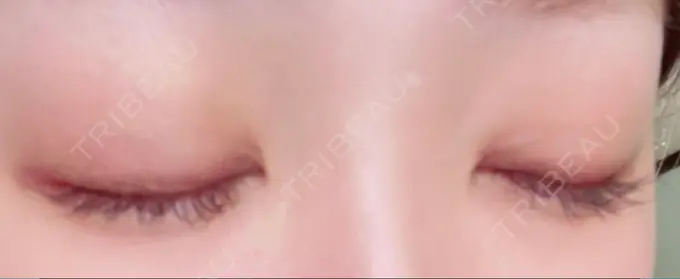 二重埋没 / ヒアルロン酸注入（目の下） EMMA CLINIC（エマクリニック） DAY 7 メイン用