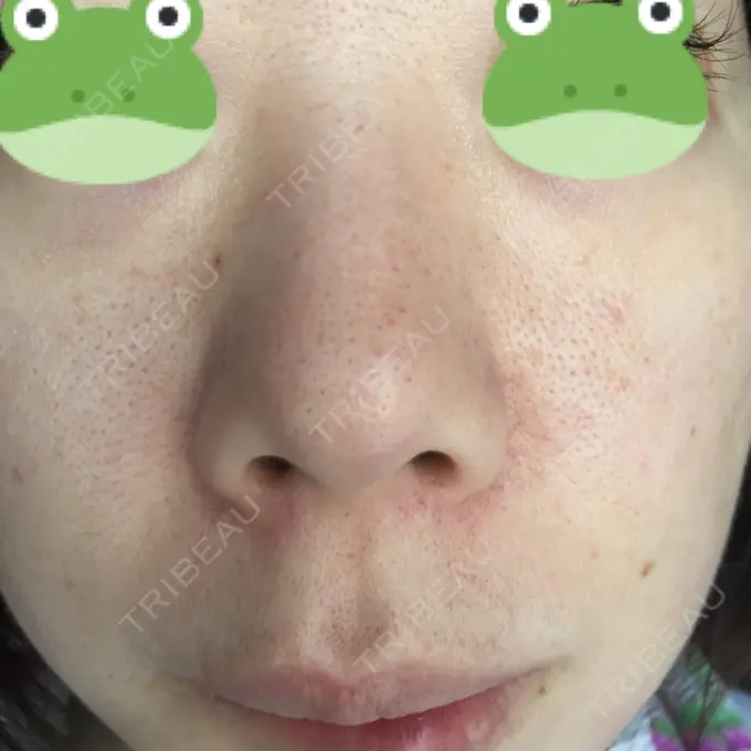 毛穴洗浄（ハイドラフェイシャルなど） / ピコレーザートーニング（美白・肝斑） / フラクショナルレーザー（毛穴・ニキビ跡） B-LINE CLINIC 池袋院 DAY 5 メイン用