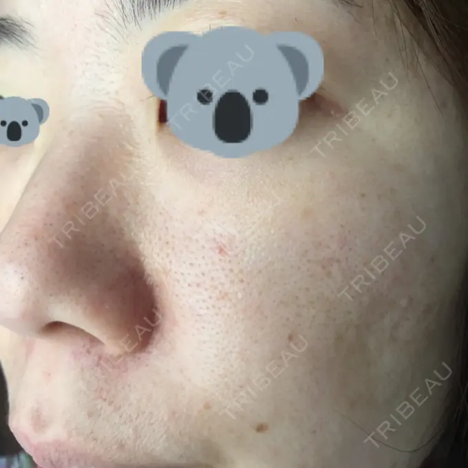 毛穴洗浄（ハイドラフェイシャルなど） / ピコレーザートーニング（美白・肝斑） / フラクショナルレーザー（毛穴・ニキビ跡） B-LINE CLINIC 池袋院 DAY 5 メイン用