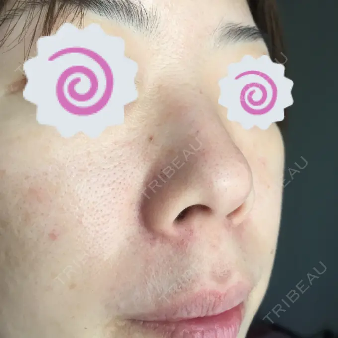 毛穴洗浄（ハイドラフェイシャルなど） / ピコレーザートーニング（美白・肝斑） / フラクショナルレーザー（毛穴・ニキビ跡） B-LINE CLINIC 池袋院 DAY 5 メイン用