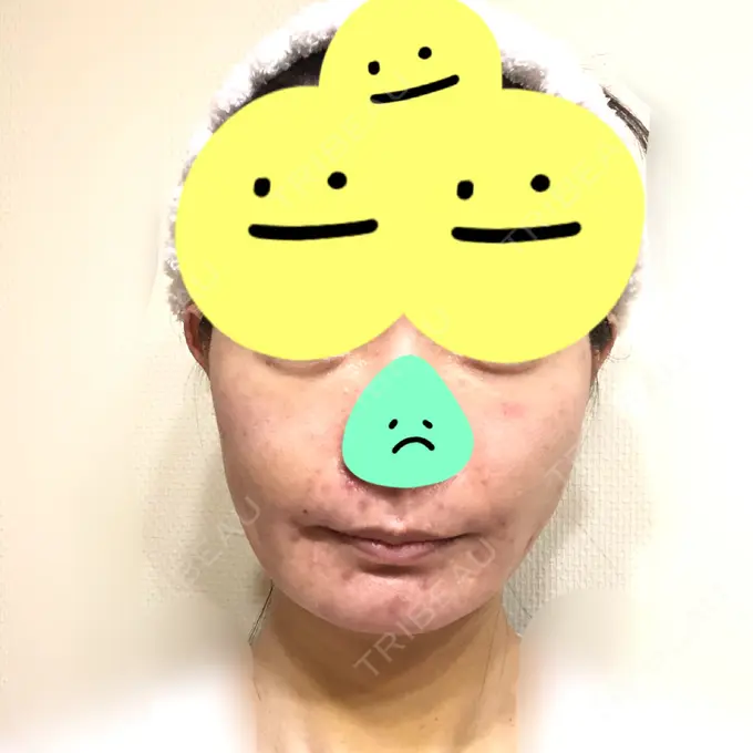 糸リフト / 脂肪吸引（顔） / 脂肪注入（肌） / メーラーファット除去 / ボトックス（エラ・小顔） 湘南美容クリニック 秋葉原院 DAY 7 メイン用