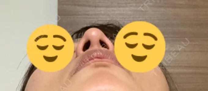 鼻尖形成（切開） / 軟骨移植 THE ROPPONGI CLINIC（ザ 六本木クリニック） DAY 120 メイン用