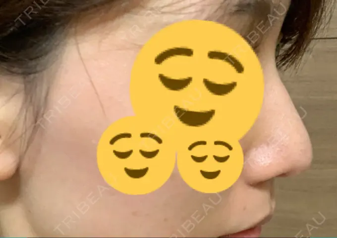 鼻尖形成（切開） / 軟骨移植 THE ROPPONGI CLINIC（ザ 六本木クリニック） DAY 120 メイン用