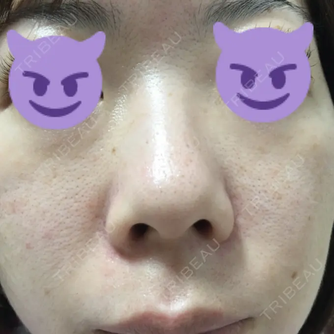 毛穴洗浄（ハイドラフェイシャルなど） / ピコレーザートーニング（美白・肝斑） / フラクショナルレーザー（毛穴・ニキビ跡） B-LINE CLINIC 池袋院 DAY 6 メイン用