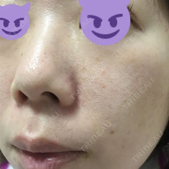 毛穴洗浄（ハイドラフェイシャルなど） / ピコレーザートーニング（美白・肝斑） / フラクショナルレーザー（毛穴・ニキビ跡） B-LINE CLINIC 池袋院 DAY 6 メイン用