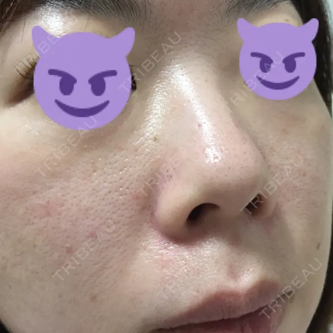 毛穴洗浄（ハイドラフェイシャルなど） / ピコレーザートーニング（美白・肝斑） / フラクショナルレーザー（毛穴・ニキビ跡） B-LINE CLINIC 池袋院 DAY 6 メイン用