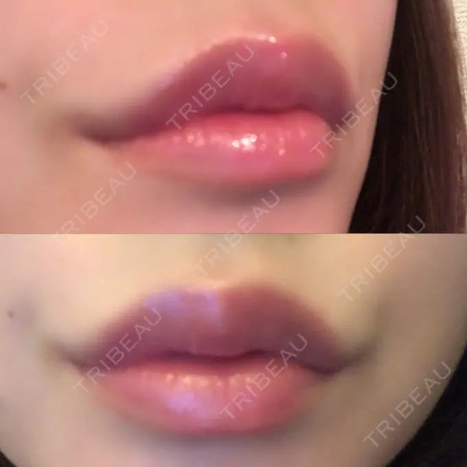 人中短縮 / ヒアルロン酸注入（唇） / ボトックス（口角） ルラ美容クリニック 高田馬場院 DAY 19 メイン用