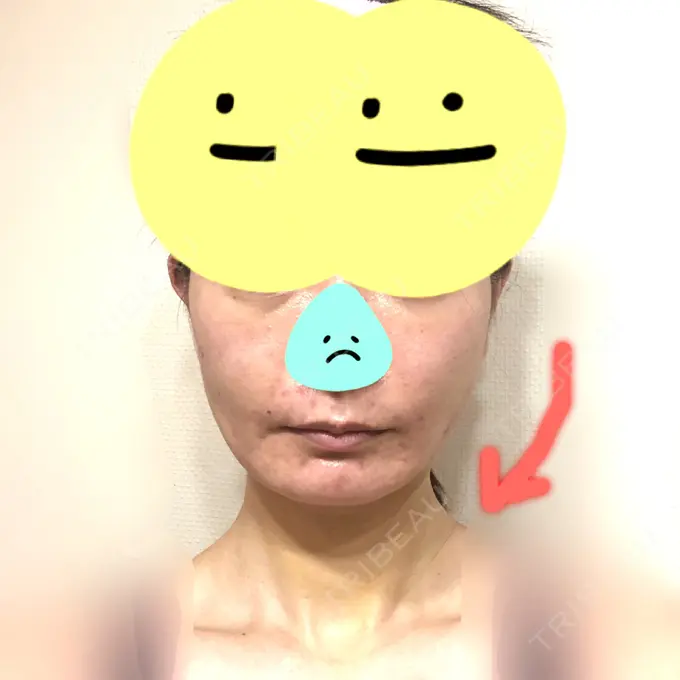 糸リフト / 脂肪吸引（顔） / 脂肪注入（肌） / メーラーファット除去 / ボトックス（エラ・小顔） 湘南美容クリニック 秋葉原院 AFTER メイン用