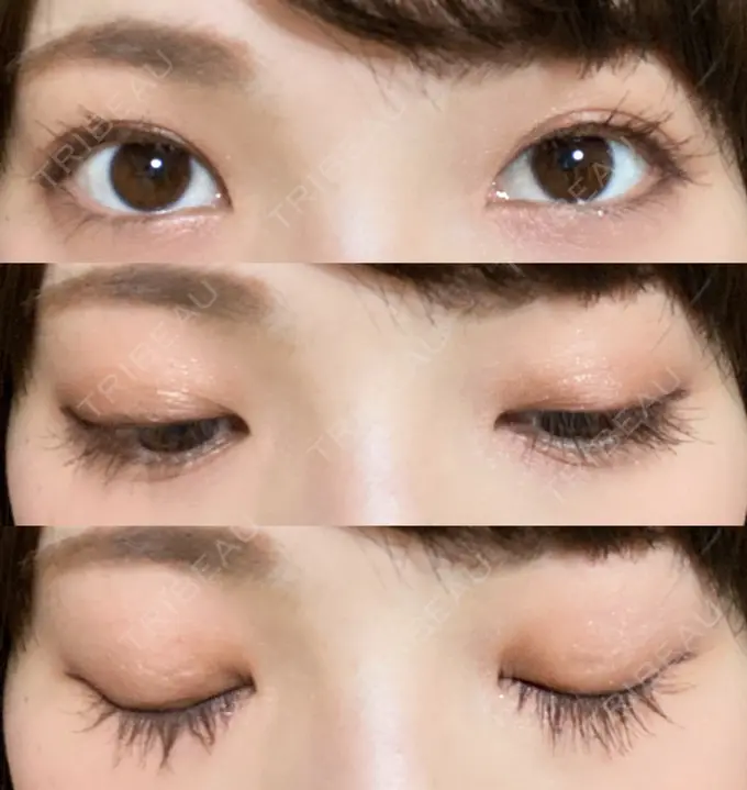 二重切開 有楽町高野美容クリニック DAY 207 メイン用