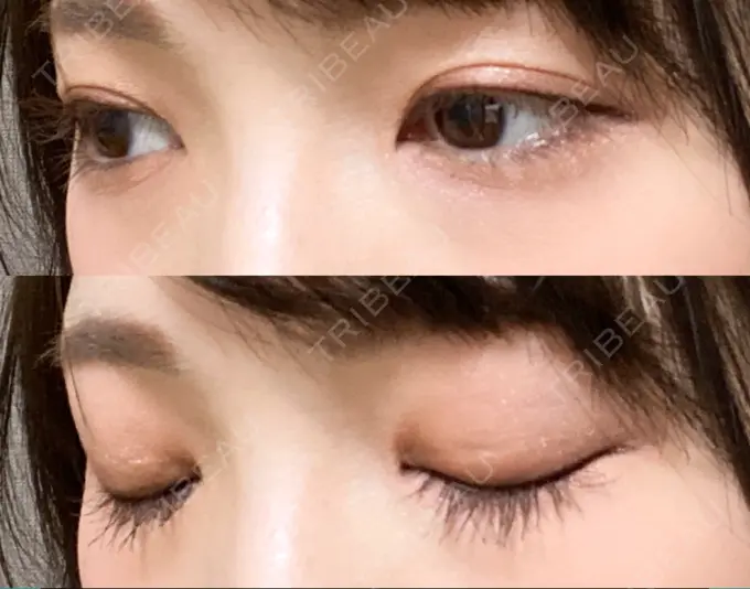 二重切開 有楽町高野美容クリニック DAY 207 メイン用